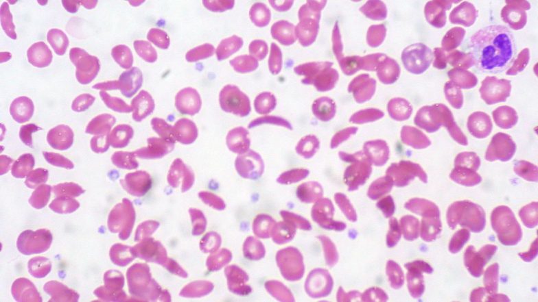 World Sickle Cell Day 2019: Theme, Significance of the Day For Raising Awareness About the Inherited Disorder