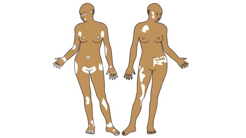 World Vitiligo Day 2019: Theme, Significance of the Day; How Vitiligo Affects Mental Health