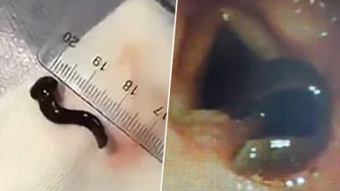 Leech Removed From Chinese Woman’s Throat! Watch Video of Doctors Extracting the 3cm-Long Blood-Sucking Parasite