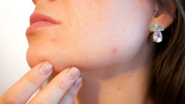 Cell Phone Giving You Acne? 5 Unexpectedly Germy Everyday Objects That Are Damaging Your Skin