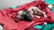 Three-Headed Baby Born in Uttar Pradesh: What is Encephalocele? Know Everything About This Condition