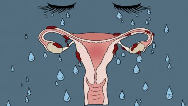 Endometriosis Awareness Month 2021: What Is Endometriosis and How Does it Affect Your Menstrual Cycle? 5 Facts About the Painful Condition That You Should Know Of