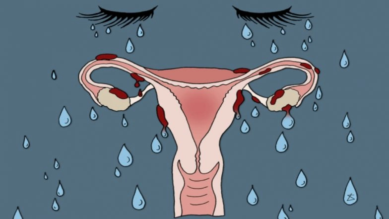Endometriosis Awareness Month 2021: What Is Endometriosis and How Does it Affect Your Menstrual Cycle? 5 Facts About the Painful Condition That You Should Know Of