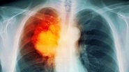 Lung Cancer Causes: 5 Sneaky Risk Factors That Have Nothing to Do with Smoking