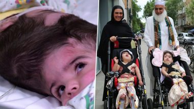 Conjoined Twins Safa and Marwa Ullah from Pakistan Separated After 55-Hour-Long Surgery in London