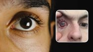 Parasites Eat Man's Eye As He Wore Contact Lenses in Shower Making Him Go Blind