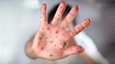 Measles Outbreak: How to Protect You and Your Children From This Viral Infection