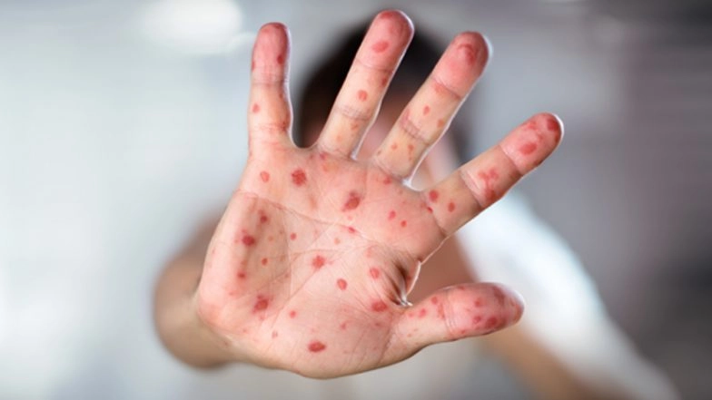 Measles Outbreak in Bangladesh: Emergency Vaccination Drive Launched Amid Rising Child Deaths