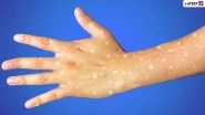 What Are the White Spots on Your Skin and Should You Be Worried? Know More About Idiopathic Guttate Hypomelanosis