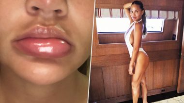 Chrissy Teigen Shares Pic of ‘About to Explode’ Swollen Lip on Twitter; What is Angioedema?