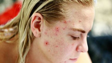 Patients with Acne Have Significant Risk of Developing Depression