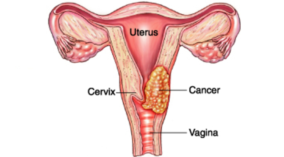 Promoting cervical cancer screening among female