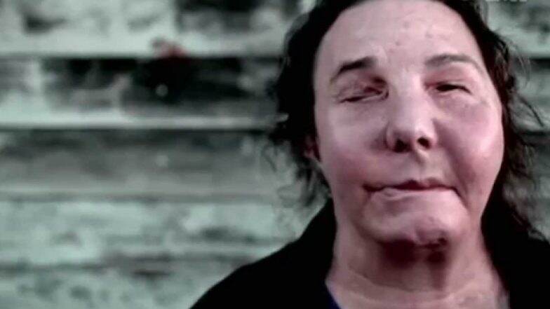 Face Transplant Patient from US In Need of New Donor As Facial Tissue Show Signs of Damage 6 Years After Surgery Face Transplant Patient from US In Need of New Donor As Facial Tissue Show Signs of Damage 6 Years After Surgery