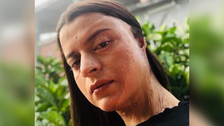 Rangoli Chandel Recalls Her Acid Attack Ordeal