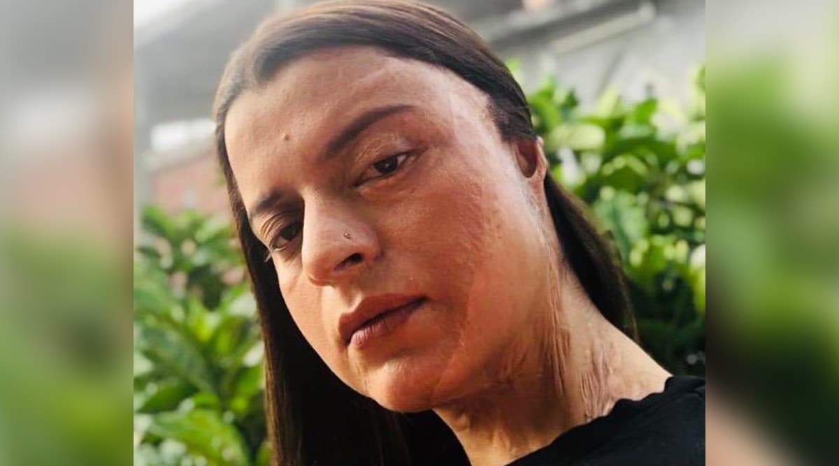 Rangoli Chandel Recalls Her Acid Attack Ordeal Rangoli Chandel Recalls Her Acid Attack Ordeal
