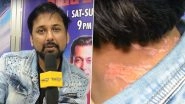 Bigg Boss 13 Shocker! Siddhartha Dey Shows Burn Injuries He Sustained after Bleach Was Poured on Him (Watch Video)