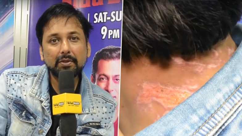 Bigg Boss 13 Shocker! Siddhartha Dey Shows Burn Injuries He Sustained after Bleach Was Poured on Him (Watch Video)