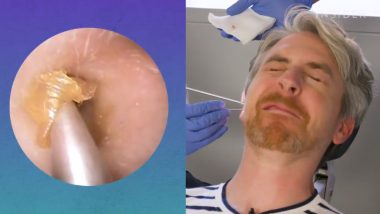 How to Remove Earwax? This Viral Video Is Disgusting and Satisfying in Equal Parts