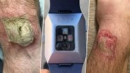 Fitbit Blasts on a Man&rsquo;s Hand and Allegedly Causes &lsquo;Third-Degree Burns&rsquo; and Nerve Damage (View Graphic Images)
