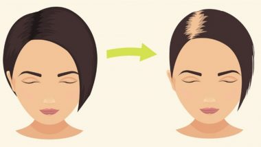 Hair Loss Causes: Is Your Hair Fall Normal? How Much Shedding Is OK and  When Should It Be a Concern | 🍏 LatestLY