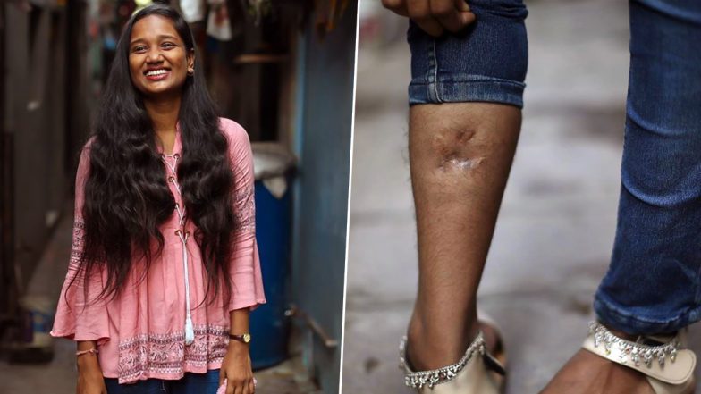 26/11 Survivor Devika Rotawan Who Was Shot by Ajmal Kasab on Right Leg Recollects Horrific Mumbai Attack, Says She Wants to be IPS officer