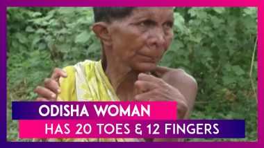Rare! A Woman In Odisha’s Ganjam Has 20 Toes And 12 Fingers