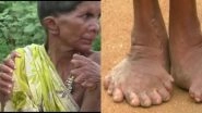 Odisha Woman Born With 20 Toes and 12 Fingers is Branded a Witch (View Pics)