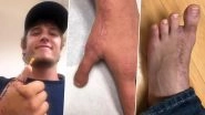 US Man Lost His Thumb While Making Gift for His Girlfriend; Surgeons Replace It With His Toe