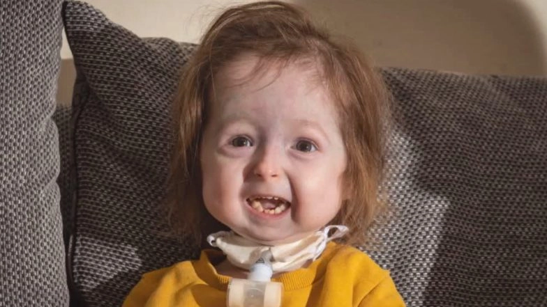 Progeria Syndrome: UK Girl Is the Only Person in the World to Have a Type of Benjamin Button Disease, Father Embraces the Condition and Lovingly Calls Her 'Grandma'