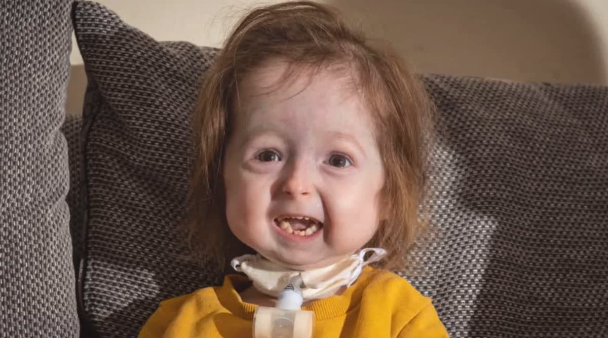 Progeria Syndrome Uk Girl Is The Only Person In The World To Have