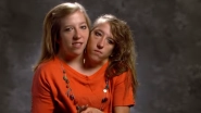World's Most Conjoined Twins How Driving And Have Separate Careers! (Watch Video)