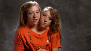 World's Most Conjoined Twins How Driving And Have Separate Careers! (Watch Video)
