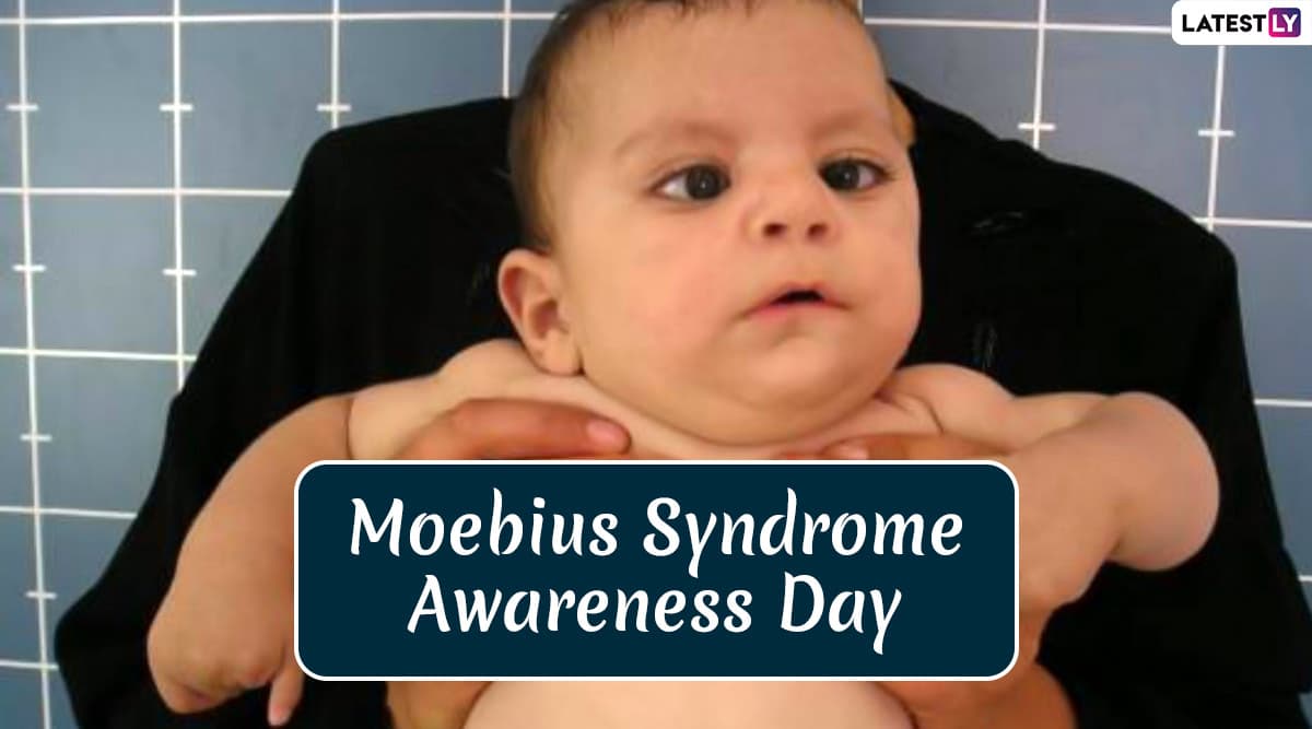 Moebius Syndrome Awareness Day 2020: Date and Significance of the Day Dedicated to the Rare Neurological Condition Moebius Syndrome Awareness Day 2020: Date and Significance of the Day Dedicated to the Rare Neurological Condition