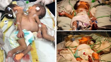 Jodhpur: Conjoined Twins Separated Successfully by Doctors at AIIMS