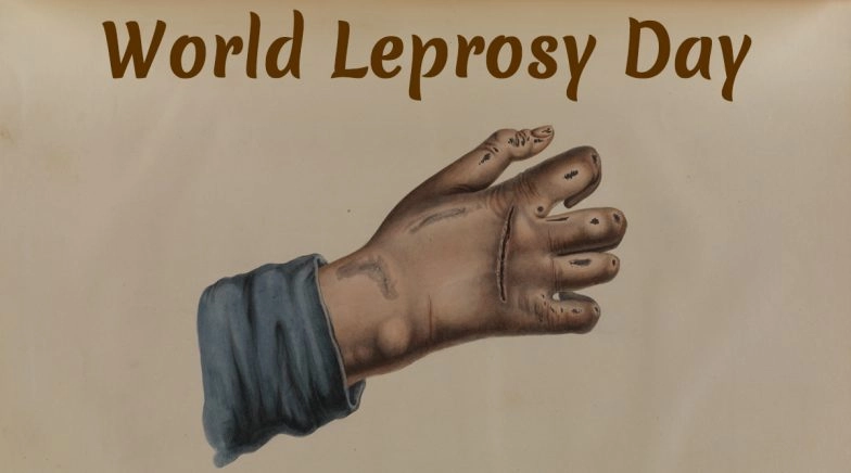 World Leprosy Day 2020: What Is Leprosy? Know More About the Causes, Symtoms and Treatment of  Hansen’s Disease