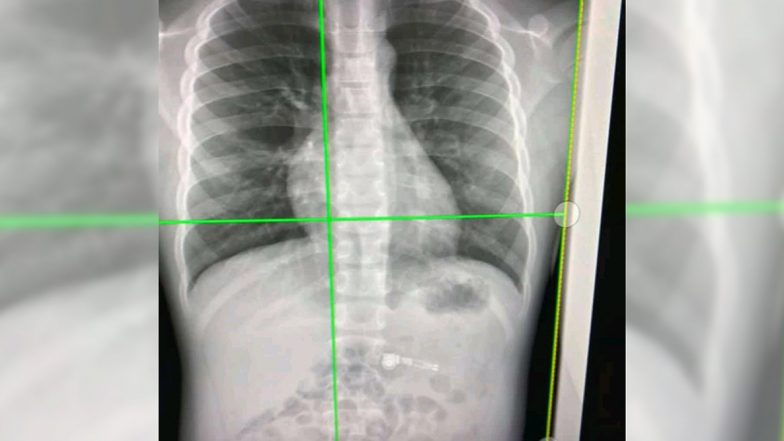 7 Year-old Boy Accidentally Swallows Apple Airpod; Gets Hospitalised