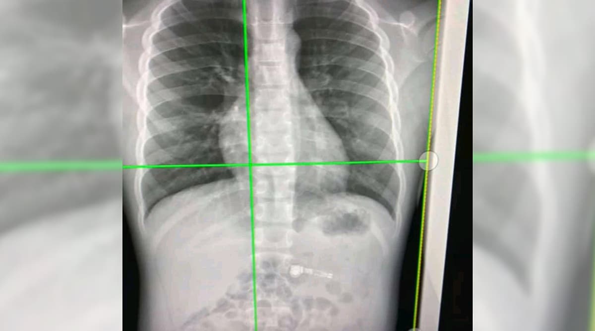 7 Year-old Boy Accidentally Swallows Apple Airpod; Gets Hospitalised 7 Year-old Boy Accidentally Swallows Apple Airpod; Gets Hospitalised
