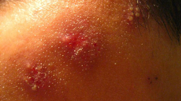 Adults Re-Exposed to Chickenpox Are Less Likely to Get Shingles