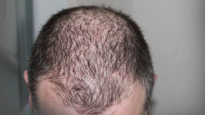 Does Iron Deficiency Lead to Hair Fall; From Eggs to Spinach, Foods One Must Eat for a Healthy Scalp