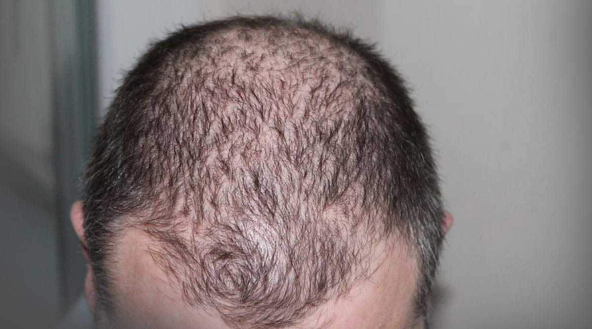 Thinning hair could indicate female pattern baldness  Dr Batras