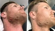 Jimmy Neesham Injures Jaw During India A vs New Zealand A Match, Kiwi All-Rounder Shares Picture With a Hillarious Caption