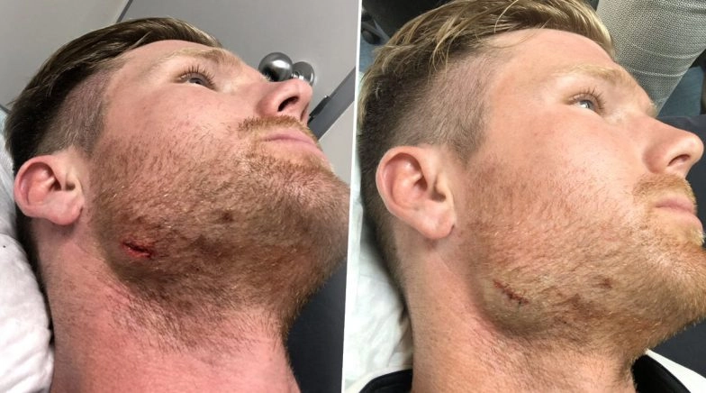 Jimmy Neesham Injures Jaw During India A vs New Zealand A Match, Kiwi All-Rounder Shares Picture 