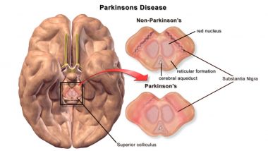 Parkinson’s Disease Symptoms and Signs That Must Not Be Ignored