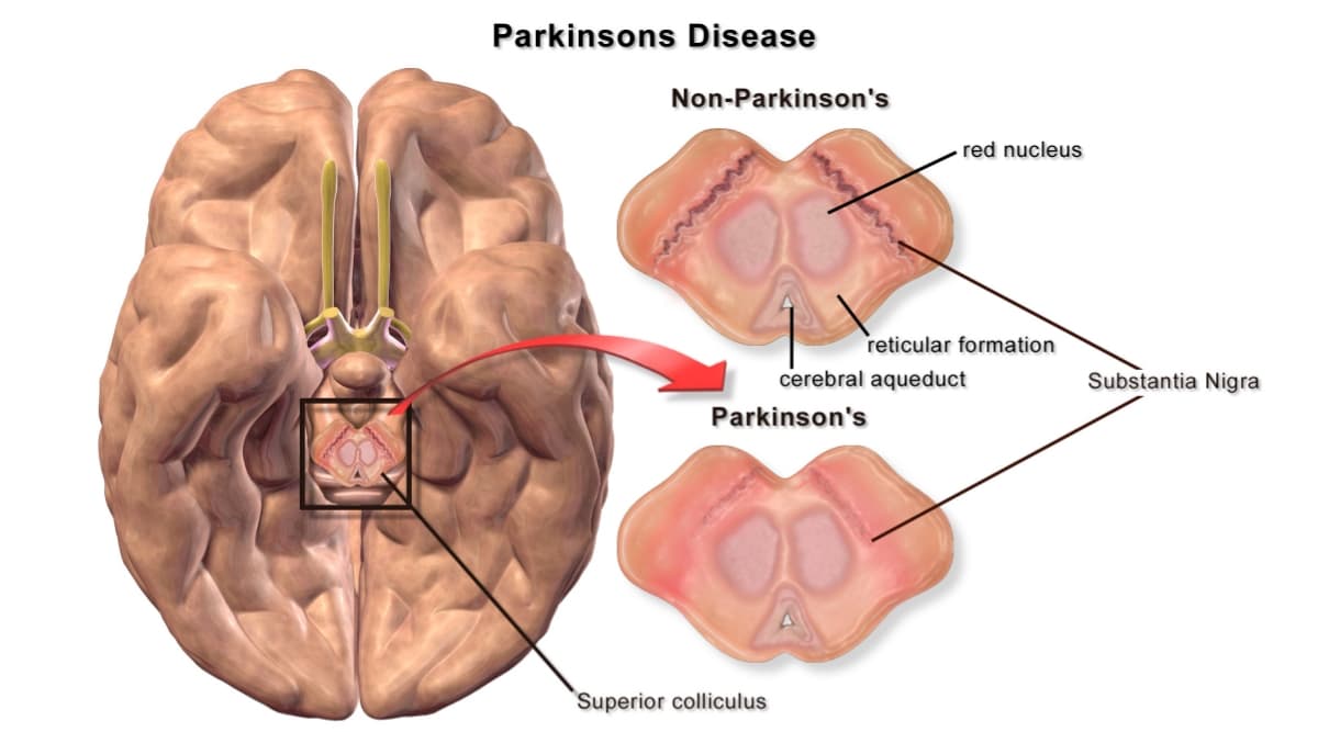 Parkinson’s Disease Symptoms and Signs That Must Not Be Ignored Parkinson’s Disease Symptoms and Signs That Must Not Be Ignored