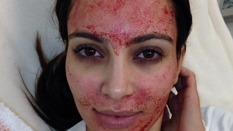 Skincare Trends 2020: From Lip Lifts to Platelet-Rich Plasma, 5 Biggest Beauty Treatments That Will Be a Hit in the Brand New Year