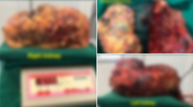 Kidneys Weighing 7 Kgs and 5.8 Kgs Removed From a 41-Year-Old Patient