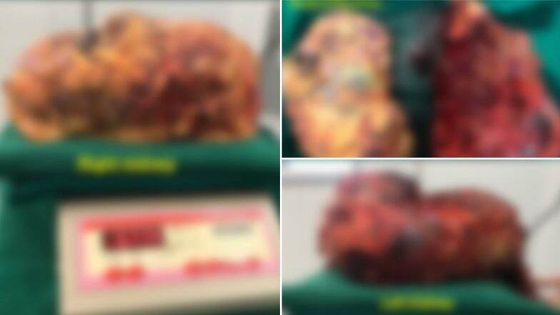 Kidneys Weighing 7 Kgs and 5.8 Kgs Removed From a 41-Year-Old Patient of Autosomal Dominant Polycystic Kidney Disease (ADPKD)