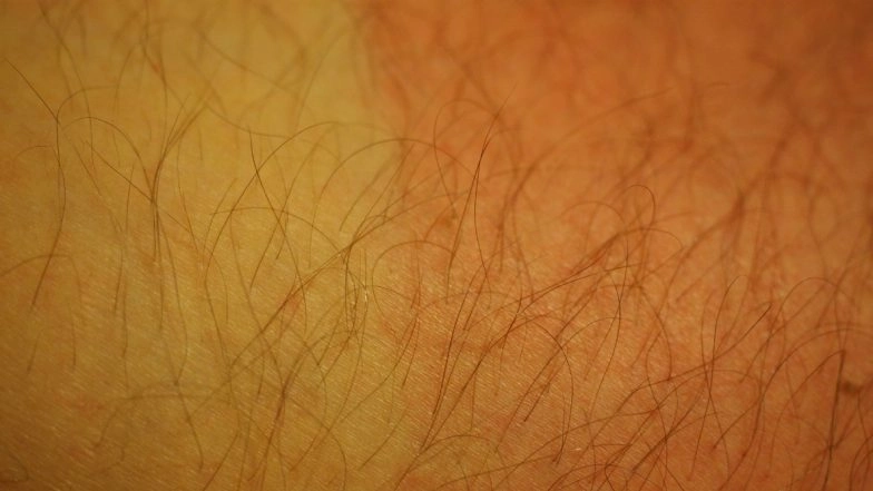 World Cancer Day 2020: From Viagra to Frequent Flying, 5 Surprising Things That Increase Your Risk of Skin Cancer