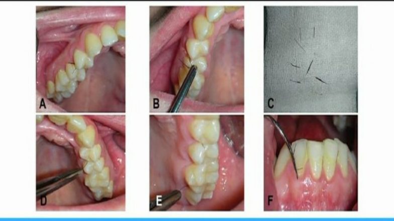 Eyelash-Like Hair Grows Inside Woman's Gums Due to Rare Medical Condition Associated With PCOS (View Pic)