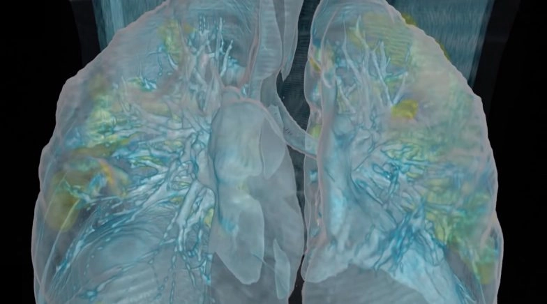 Lung Damage in Coronavirus Patients: Video by Washington DC Hospital Releases 